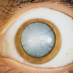 ЛЕЧЕНИЕ КАТАРАКТЫ