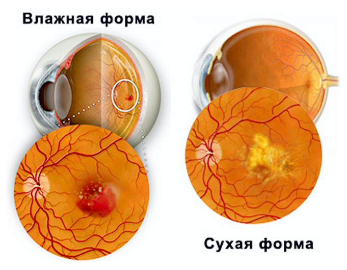 Улучшилось зрение линзы
